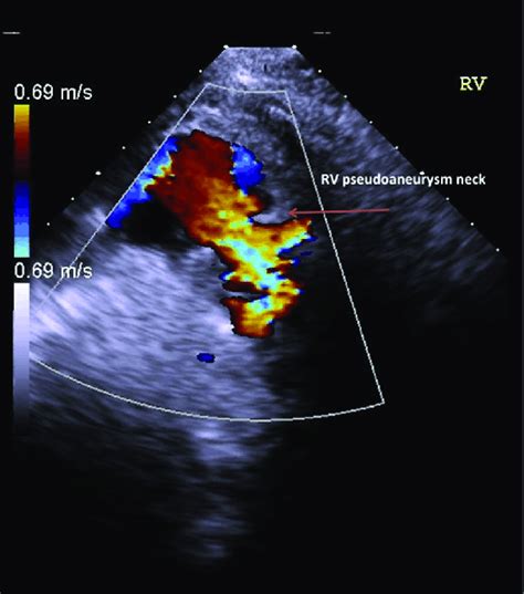 2d echo with doppler|Echocardiogram/Doppler Transthoracic .